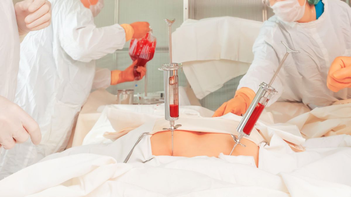 Csontvelő transzplantáció - életet menthet az egyszerű vérvétel